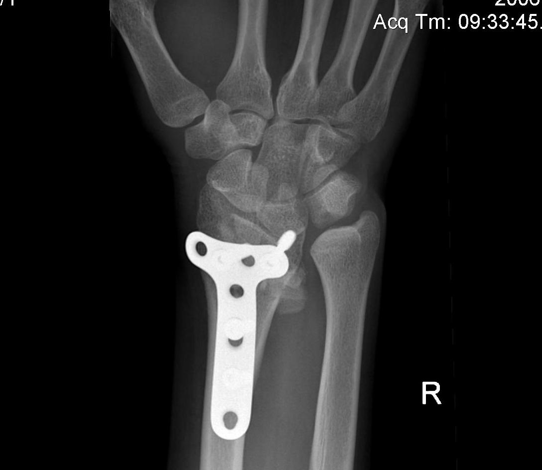 Madelung's Osteotomy